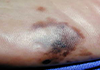 Acral melanoma on heel of foot
