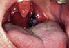 Mucosal Melanoma in the mouth