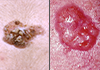 Basal Cell Carcinoma and Squamous Cell Carcinoma