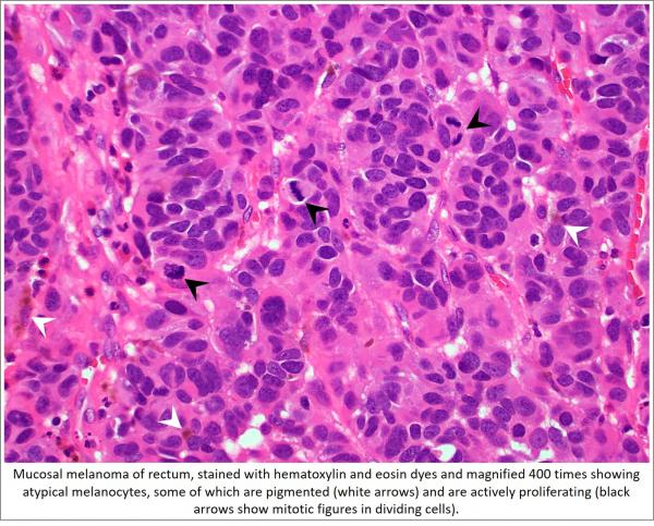 Mucosal melanoma MRA